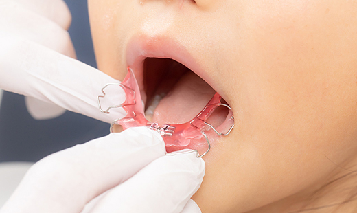 床矯正 顎の成長を助ける！