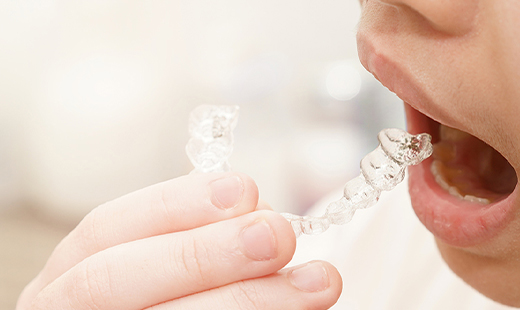 インビザラインファースト