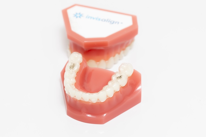 インビザラインとは