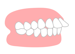 出っ歯の定義と判断基準