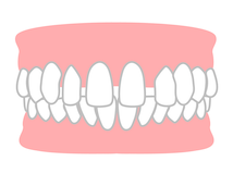 すきっ歯とは
