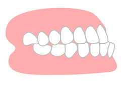 しゃくれ（受け口）とは