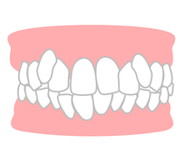歯並びがでこぼこ（叢生）とは？